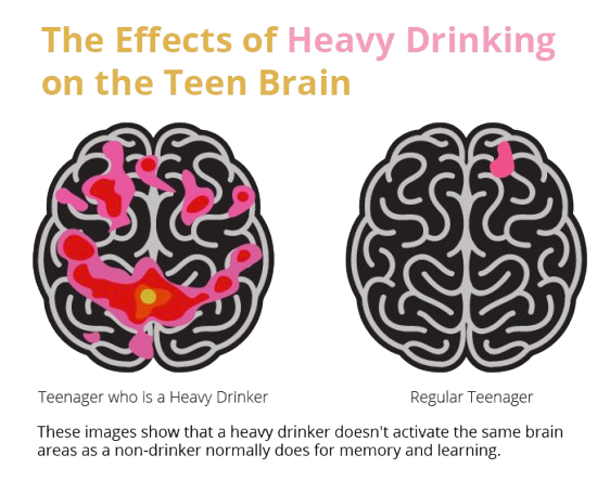 Comparativa entre el cervell d'un adolescent bevedor i el d'un no bevedor